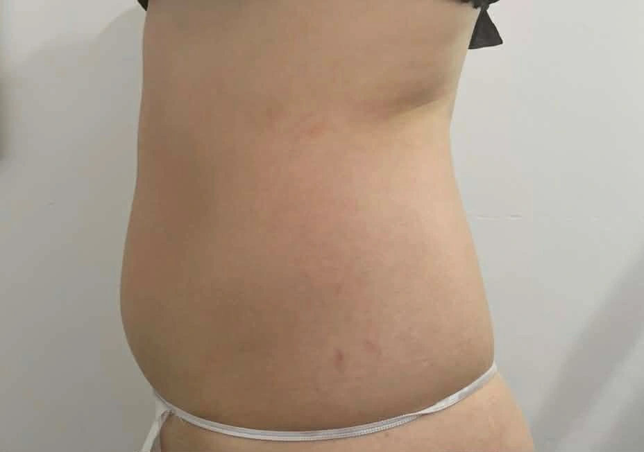 Ciało po zabiegu Magnifico